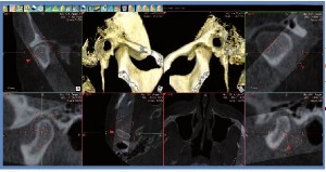 Анализ височно-нижнечелюстного сустава, томограф компьютерный конусно-лучевой WhiteFox