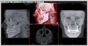 Ортодонтия, томограф компьютерный конусно-лучевой WhiteFox